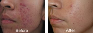 acne scarring before and after