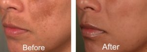 melasma before and after